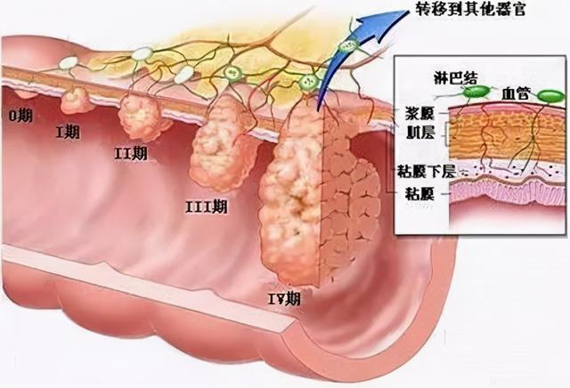 结直肠癌为什么需要基因检测？