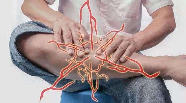 睡觉腿抽筋是咋回事?医生:别盲目补钙,还有可能是这3种原因