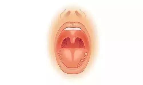 化疗后口腔溃疡怎么办 乳腺癌康复圈 觅健 化疗后口腔溃疡怎么办 乳腺癌康复圈 觅健