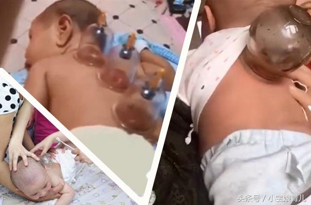网传：婴儿拔罐险伤内脏致命，小孩拔罐好吗？