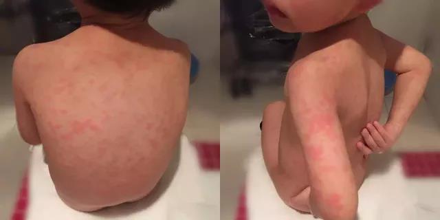 严重的手足口病可引起肺水肿！预防宝宝手足口病，要做到这4点