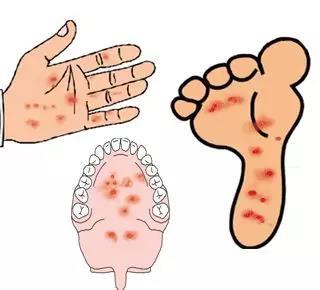 严重的手足口病可引起肺水肿！预防宝宝手足口病，要做到这4点