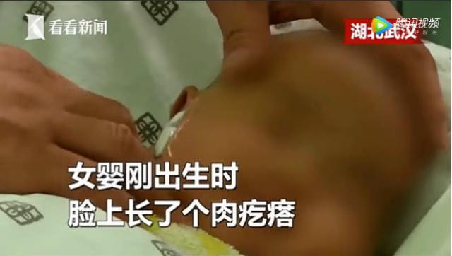 奶奶用发丝帮孙女除面部肉疙瘩，险些致孙女丧生，你敢这样做吗？