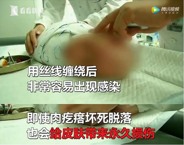 奶奶用发丝帮孙女除面部肉疙瘩，险些致孙女丧生，你敢这样做吗？