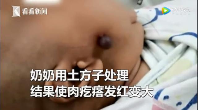 奶奶用发丝帮孙女除面部肉疙瘩，险些致孙女丧生，你敢这样做吗？