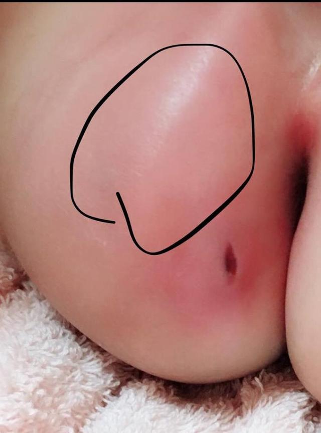请先洗手再接触小孩！差点蜂窝性组织扩散全身，这病感染恐致死