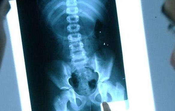 X光检查暴露女儿隐藏多时的秘密 母亲痛心疾首