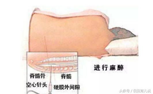 分娩时打无痛真不会疼吗？宝妈：难道我生孩子时打了假的无痛！
