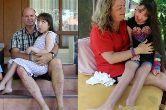 为了让女儿停止发育，父母割除了她的子宫，也许这真的是为她好