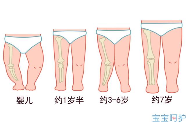 4岁前用错这些带娃用品，小心宝宝长成O型腿