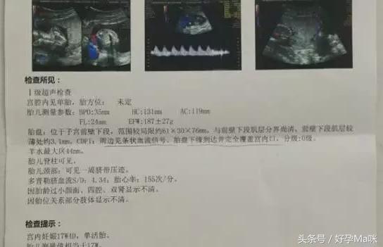 B超单上的4个字，对胎儿或许很重要，孕妈要了解