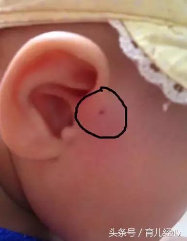 你家宝宝耳朵上有这种小孔吗？听说是“富贵命”？