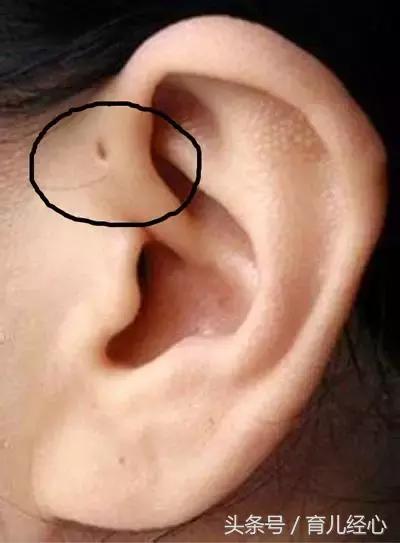 你家宝宝耳朵上有这种小孔吗？听说是“富贵命”？