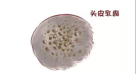 宝妈剥掉新生儿头上“脏东西”，导致婴儿高烧不退！