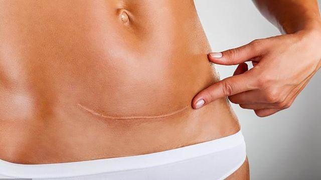 孕妇剖腹产时，竖切和横切有什么区别？了解后生二胎能少吃苦头