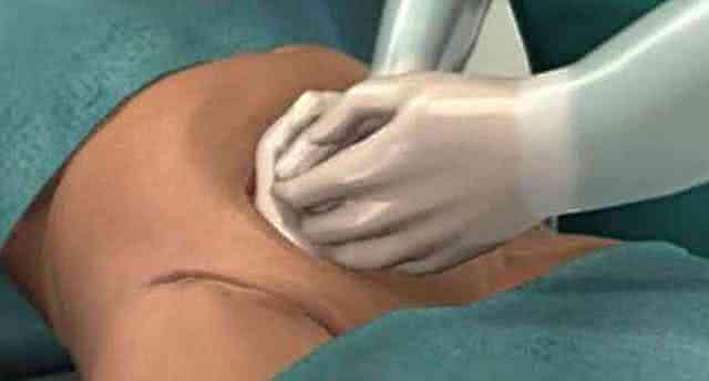 顺产和剖腹产有什么区别？爸爸们都该来看看