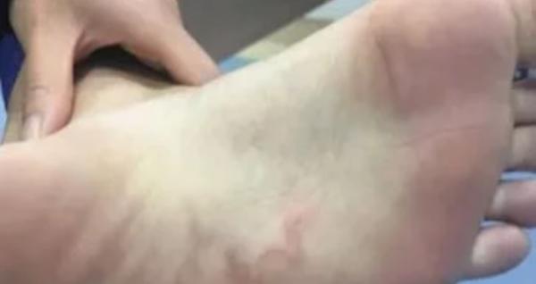 小女孩一走路就喊疼，医生划开脚底后取出它，却把家人吓坏