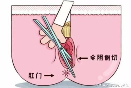 顺产都需要侧切？侧切之后的护理这6点宝妈要记住了