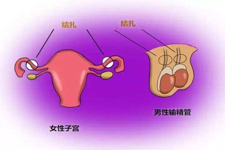 二胎宝妈们，你们生完孩子是结扎还是上环呢？