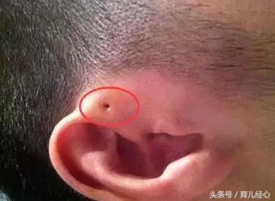 你家宝宝耳朵上有这种小孔吗？听说是“富贵命”？