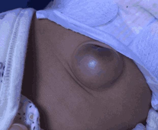 宝宝肚脐突然鼓成“球”, 妈妈们怎么改怎么办