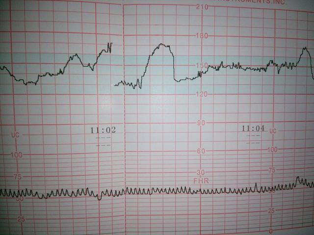 怀孕时，如果准妈妈怀的是女孩，孕检单上一般会有这样的提示