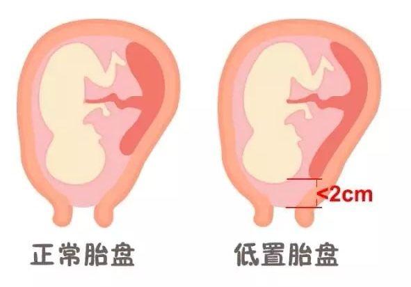 前置胎盘的宝妈们看过来，前置胎盘必须剖腹产吗？