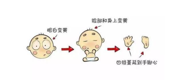 生理性黄疸和病理性黄疸，如何区分？