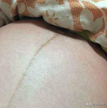 孕期肚子为什么会出现黑色妊娠线？跟胎儿性别有关系吗？来看答案