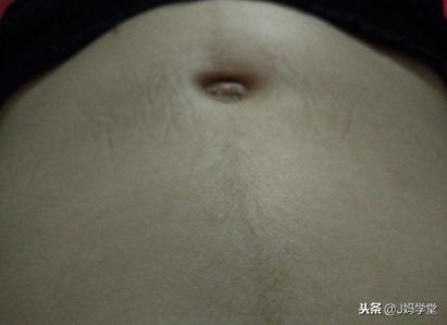 孕期肚子为什么会出现黑色妊娠线？跟胎儿性别有关系吗？来看答案