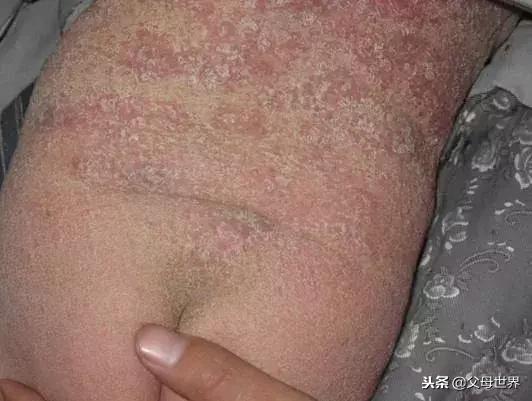 秋冬季湿疹老不好？竟不是因为“湿”！当妈的也是第一次听说！