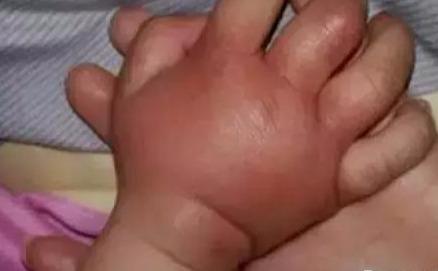 五个月的小孩手肿了，医生检查后，爸爸十分后悔