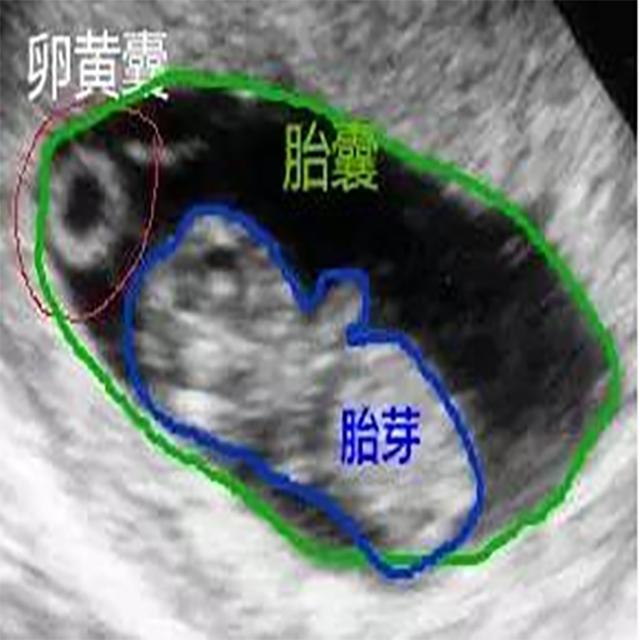为什么孕检未见胚芽以及卵黄囊的呢？急死我了，宝宝不会有事吧？
