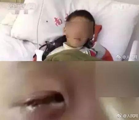 20分钟孩子眼球被溶化！医生的呼吁为所有人敲响警钟！