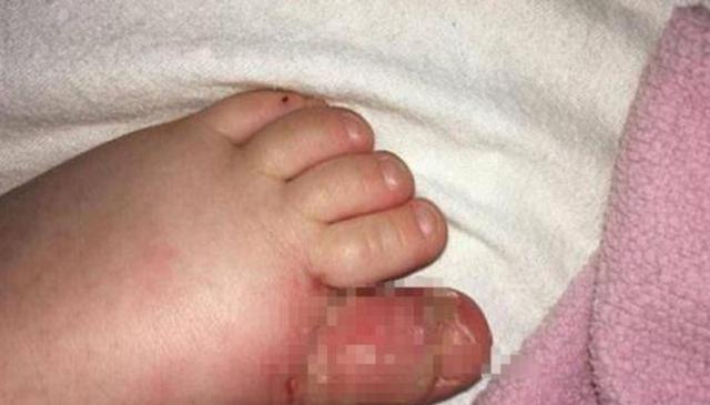 1岁女孩光着脚丫踩沙滩，大拇趾却被严重感染，让妈妈懊悔万分