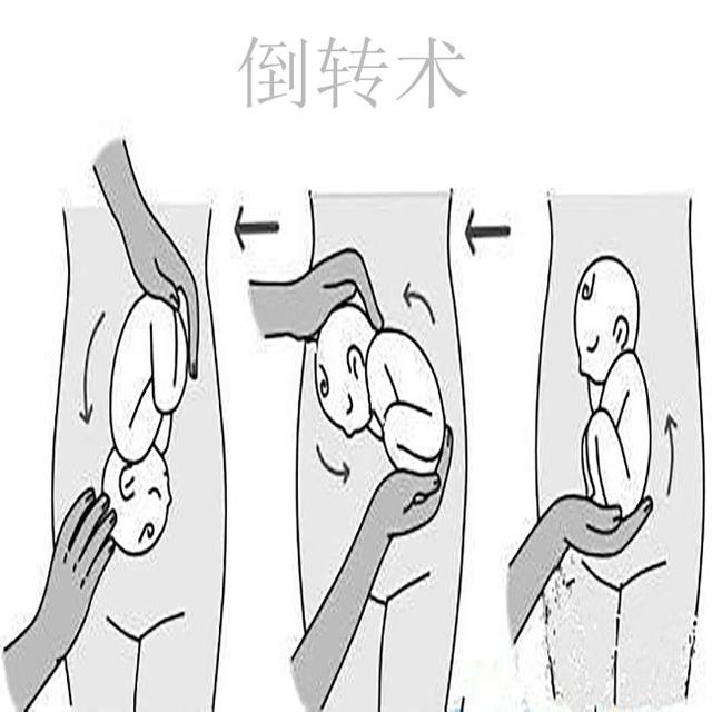 33周之前一直是头位，33W+4去查又成臀位，宝宝还可能自己转头吗