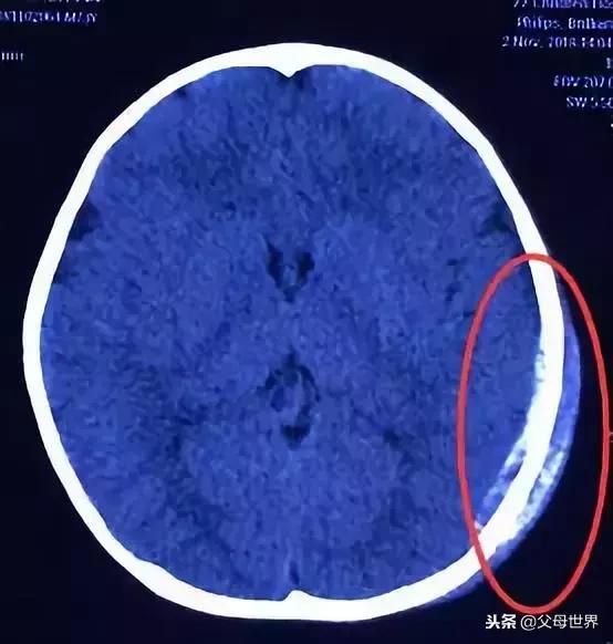3岁宝宝摔成颅内出血！商场这几个危险地方，一定别让孩子单独靠近