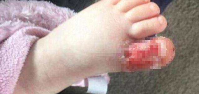 1岁女孩光着脚丫踩沙滩，大拇趾却被严重感染，让妈妈懊悔万分
