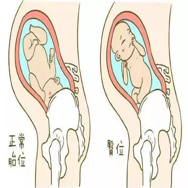 33周之前一直是头位，33W+4去查又成臀位，宝宝还可能自己转头吗