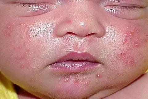 宝宝皮肤问题大全：痤疮、湿疹、头垢、淹脖子等10种及护理方法