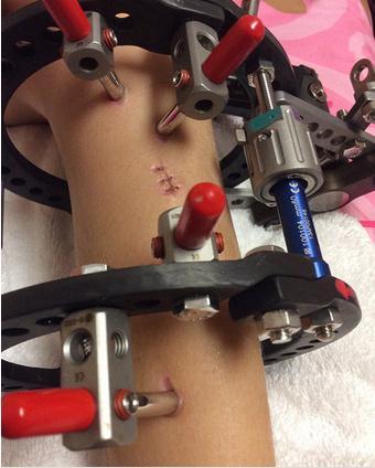 妈妈每天折断女儿腿3次，坚称这是值得的！