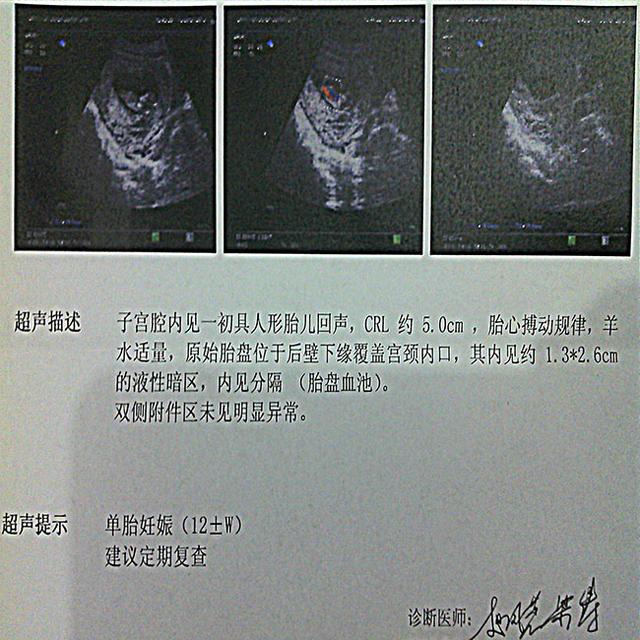 育儿说：三个多月产检胎儿偏小几天的原因，你的真了解吗？
