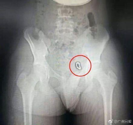 13岁男孩往“小鸡鸡”里塞了14颗磁球 一年半后才告诉父母