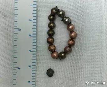 13岁男孩往“小鸡鸡”里塞了14颗磁球 一年半后才告诉父母