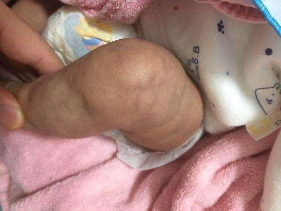 刚出生四个月的宝宝腿不对劲，掀开裤腿后，妈妈慌了神