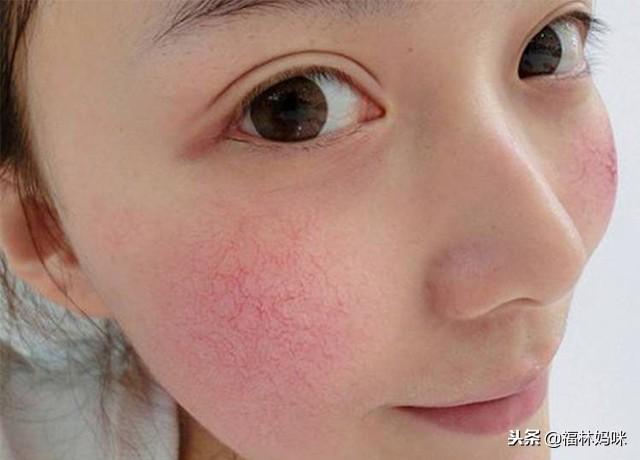 生完孩子后，脸上起皮、干痒？要警惕！你的肌肤可能已经敏感了