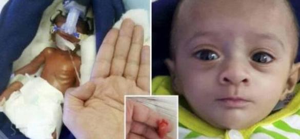 悲伤又伟大：孕妇生下一斤重龙凤胎 一周内两个宝宝都离世