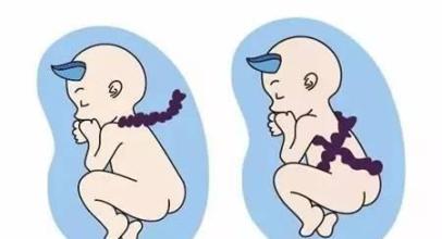 宝宝脐带绕颈，和准妈妈的这些行为有关，赶紧改正吧
