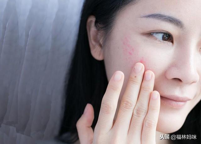 生完孩子后，脸上起皮、干痒？要警惕！你的肌肤可能已经敏感了
