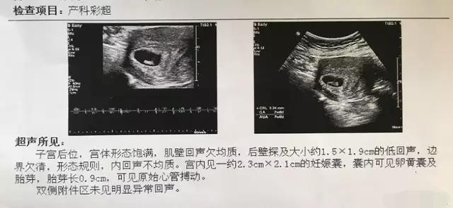 孕妇的B超单怎么看？13个指标详细解析，孕妈妈轻松看懂B超单